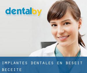 Implantes Dentales en Beseit / Beceite