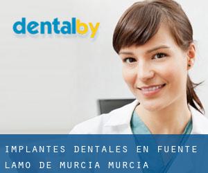 Implantes Dentales en Fuente Álamo de Murcia (Murcia)